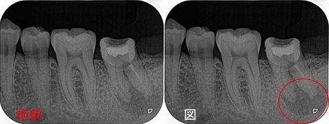 根尖病変の痛み すぐに取れる場合。取れない場合 - EE DENTAL_Blog